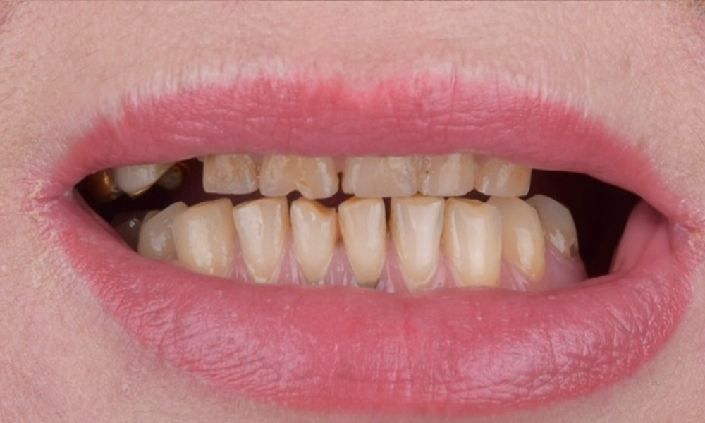 Результат лікування зубів — до
